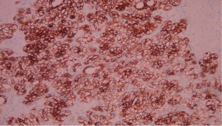 Case Reports in Surgery 3 (a) (b) (c) (d) (e) Figure 3: Immunohistochemical examination. (a) The tumor cells are positive for Cytokeratin-7 (Immunostain 200).