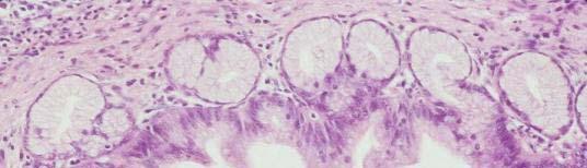 Pan IN-2 (Pancreatic Intraepithelial Neoplasia