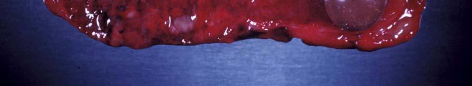 Rokitansky - Aschoff Sinuses (mucosa herniates through the