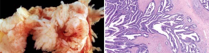 Intraductal papillary mucinous neoplasm (IPMN) Associated with the pancreatic duct Clinical spectrum: benign to malignant Intraductal Papillary Mucinous Neoplasm (IPMN) IPMT (first named in 1995)