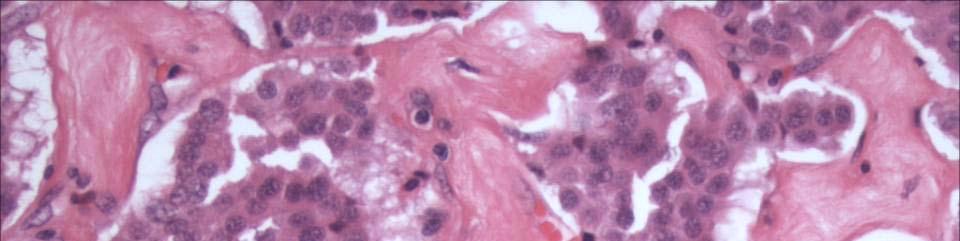 Pancreatic Endocrine Neoplasms Microscopic Nests of