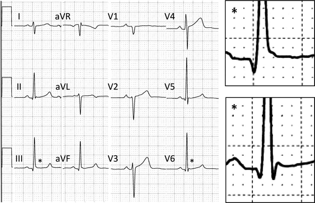 724 Derval et al. JACC Vol. 58, No. 7, 2011 Early Repolarization in Unexplained Cardiac Arrest August 9, 2011:722 8 V 6 ), or both was classified as significant early repolarization (Type 1) 