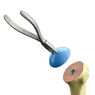 Option 1: Soft-Tissue Balancing Approach The Simpliciti STB system was designed to offer surgeons intra-operative flexibility when treating diseased and deformed anatomy.