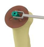 (Any excess medial bone can be trimmed with Rongeurs once the definitive implant is in place.