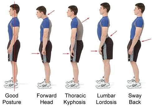 Swayback posture Lengthened external oblique & iliopsoas Shortened rectus