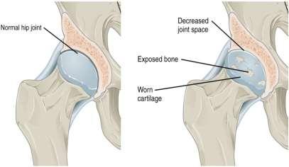 Entire joint structure is affected: Joint capsule shortening thickening& lengthening