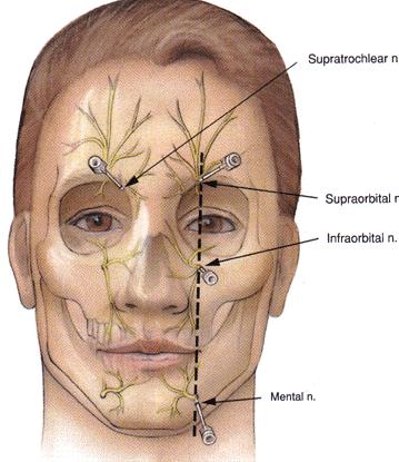 Injected Lidocaine - Tips 22 For wounds that require precise anatomic alignment, regional block preferable to infiltration No evidence that lido with epi on face, nose,