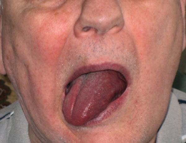 20. A patient complains that he is having difficulty speaking and that he is biting his tongue when chewing his food. The physician asks the patient to protrude his tongue (photo above).