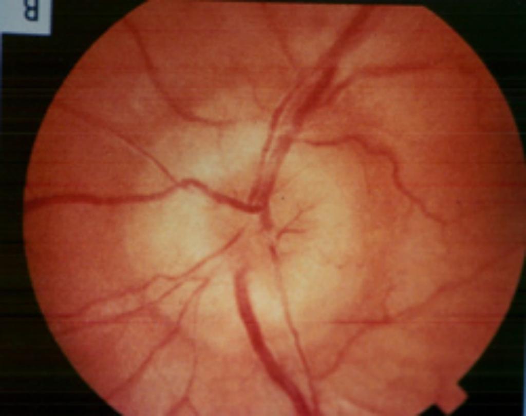 22. 49. An 85 year old woman complains of persistent headaches. Examination of the optic nerve with an ophthalmoscope (image above) shows bulging consistent with the occurrence of papilledema.