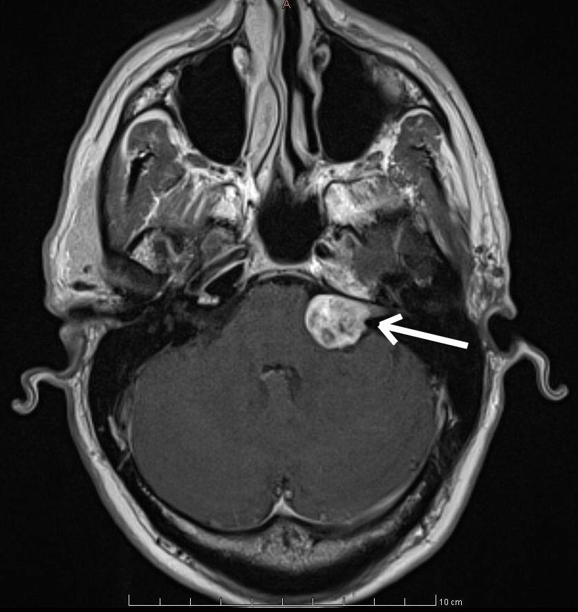 9. A 35-year-old male is referred to a neurologist because of hearing loss. The patient also states that he has begun experiencing episodes of facial weakness and drooping at the corner of the mouth.
