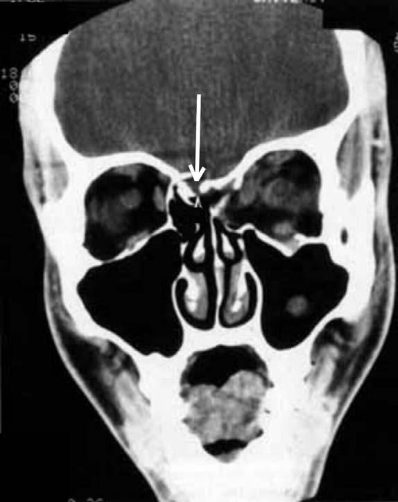 15. A patient has difficulty in swallowing. Neurological tests show that the Vagus and Glossopharyngeal nerves are normal.