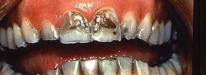How Diet Effects Teeth: Like politics: all effects are local Demineralization: most common