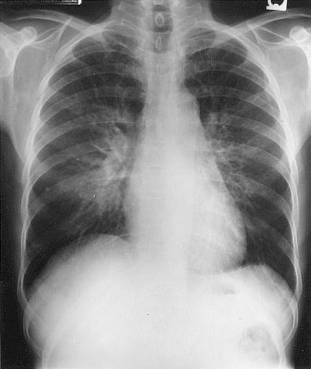 CHEST X RAY Question: How do