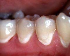 treatment Common complication of fixed orthodontic treatment Reported prevalence up to 96% The