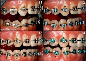spot development during orthodontic treatment, but also