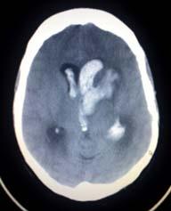 Intracerebral Bleed Middle Cerebral Infarct Neurosurgery
