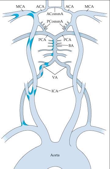 Large artery atherothromboembolism Extracranial Internal carotid artery (ICA) Common carotid artery (CCA) Vertebral artery (VA) Intracranial Internal