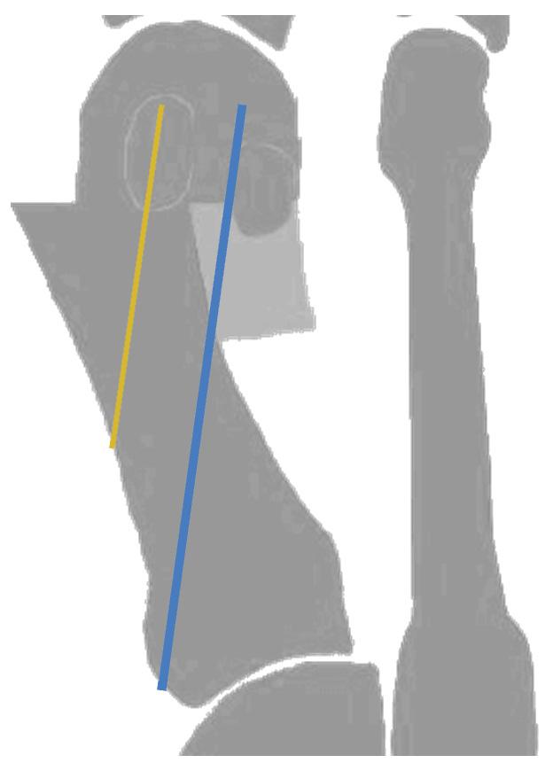 Target Guide (57700011) Place the Target Guide (57700011) into the osteotomy and orient so that the tip is located