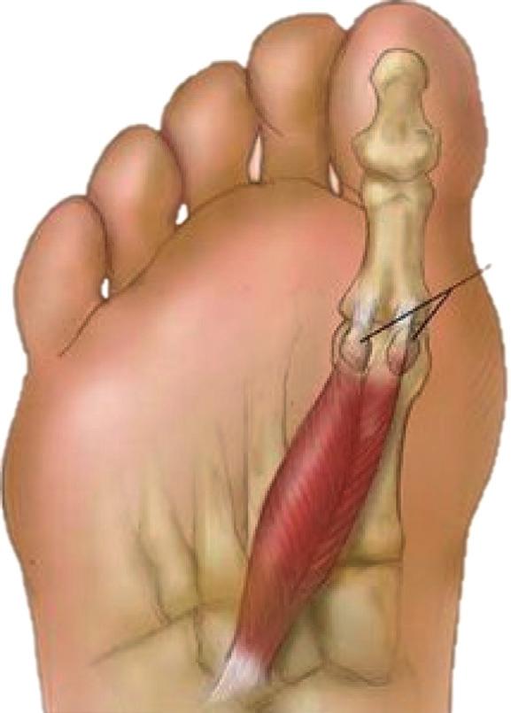 The blade is then deepened towards the plantar lateral aspect of the 1st MTPJ.