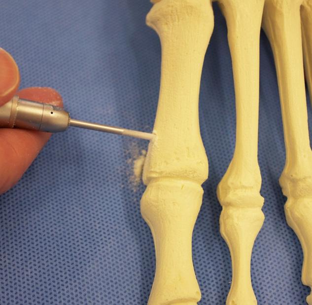 Surgical Technique 4 Chevron Osteotomy 2mm x 20mm MICA Burr (57SR0220) Patient Presentations: Hallux valgus deformity Surgical Approach 01SM64 MICA Blade 57S0MI06 MICA Blade Handle (part of a set)