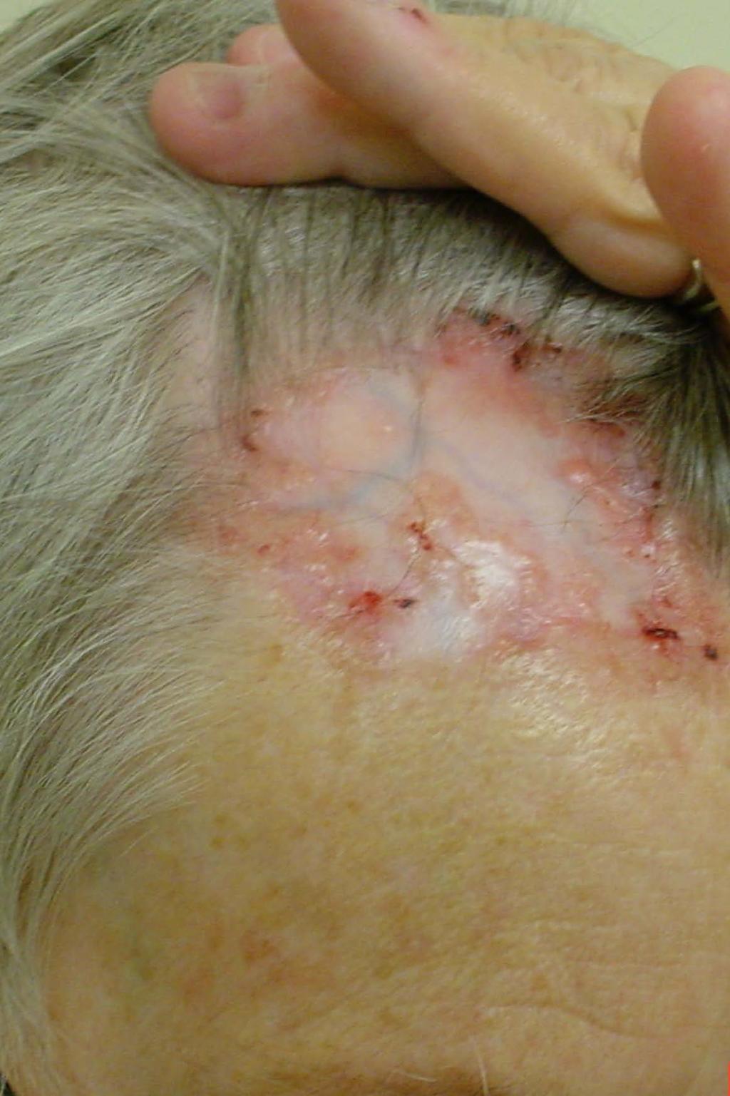 BASAL CELL CARCINOMA common >5,000,000 per year extremely low metastatic risk hig risk for local