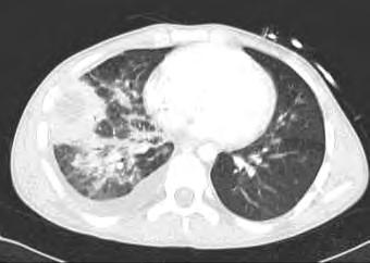 Don t judge failure too early. Review the diagnosis of aspergillosis. Are genus and species known?