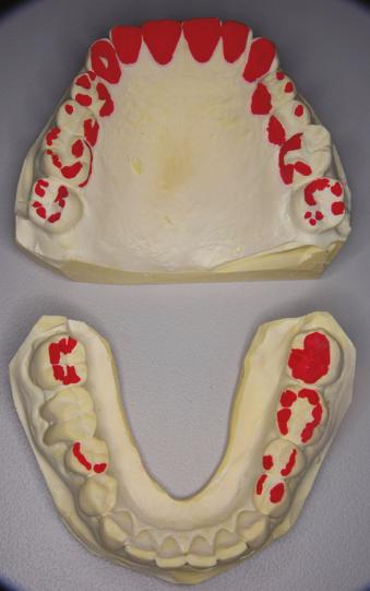 Operative Dentistry 308 Figure 5. Severe erosion was also observed on palatal surfaces in maxillary left premolars. Their palatal cusps were entirely eroded. Figure 6.