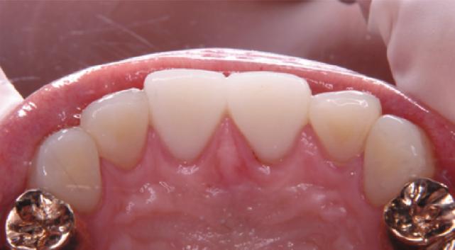Substantial loss at their incisal edges, especially in central incisors, was recovered, as can be seen from this picture taken one year after the original restorations. Figure 12.