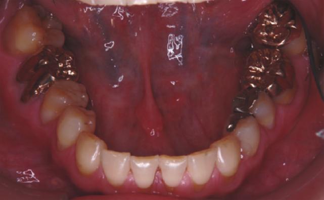 luted with a dual-cured resin cement (Panavia F, Kuraray Medical, Tokyo, Japan) in conjunction with a dentin adhesive system (SE Bond, Kuraray Medical).