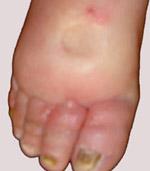 edema, reduces with elevation Stage II
