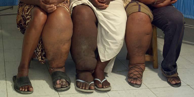 Stage III Elephantiasis Most common cause