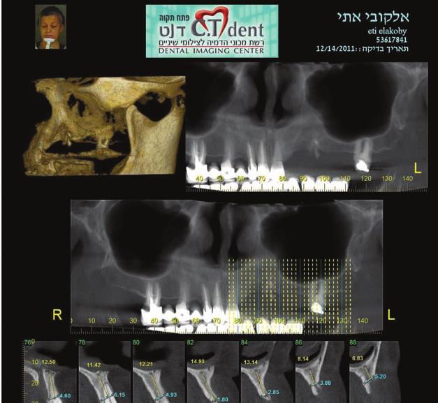 Israel Placement of a natural bovine bone to gain volume in the sinus