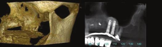 significant bone lack in both vertical and horizontal dimensions - an