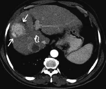 dynamic MDCT. There are two nodular lesions in segment VII and segment VIII of the liver.