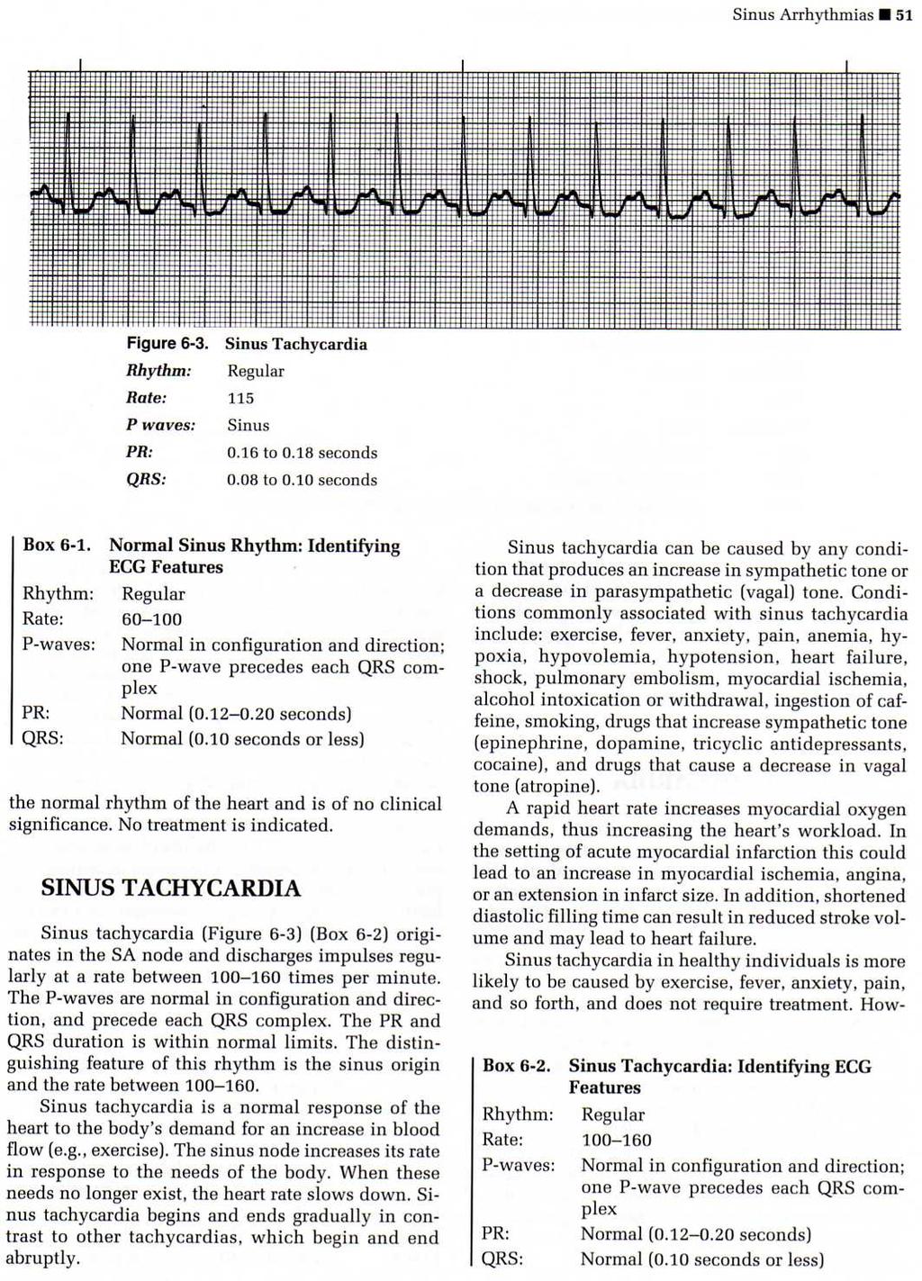 not responding to medications Sinus Tachycardia (ST) o Sinus tachycardia is a sinus rhythm of more than 100 beats per minute. Characteristics of ST: 8 Steps 3.
