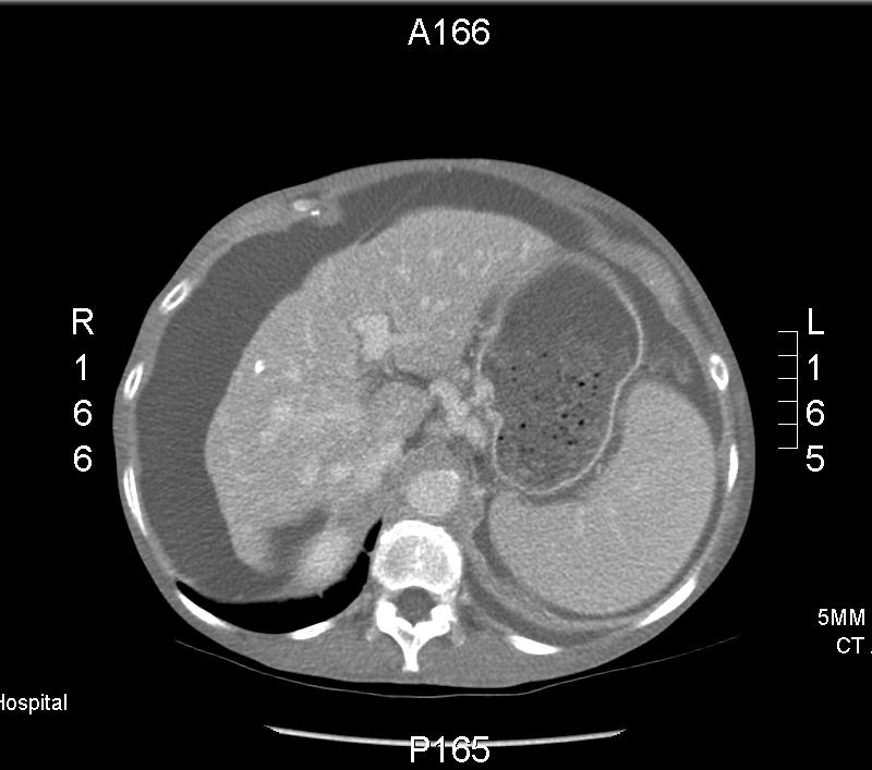Abdominal U/S Liver diffusely heterogeneous and shrunken, with evidence of contour nodularity No focal liver masses Patent vessels, normal flow by doppler Extensive gallbladder wall thickening;