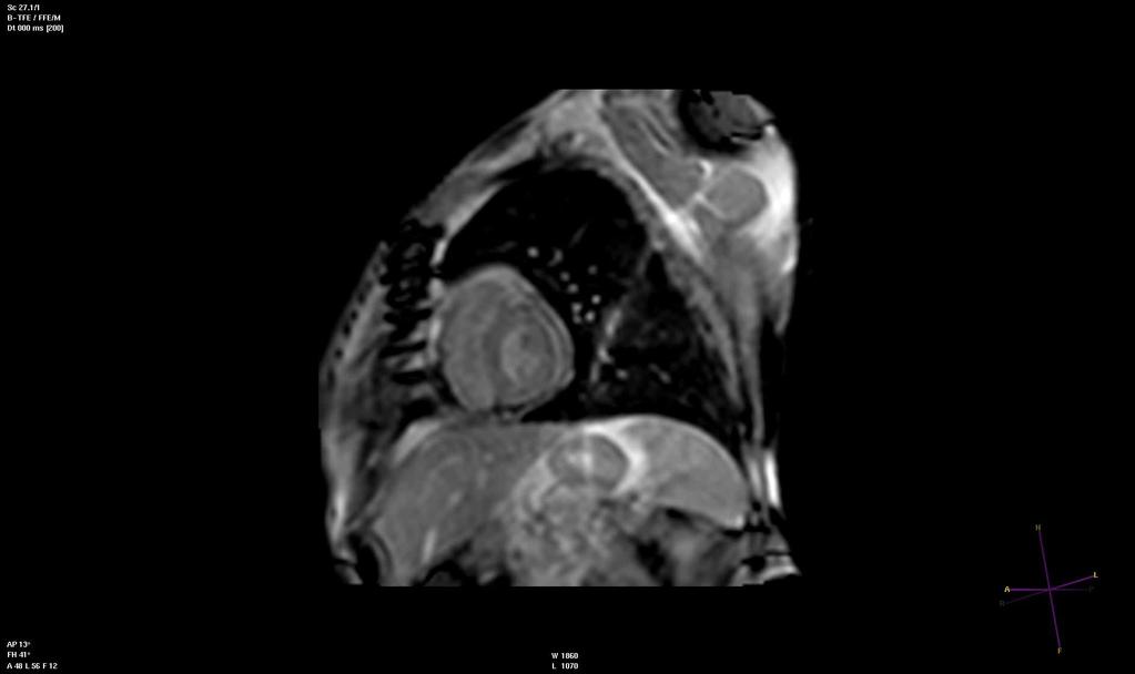 Free breathing Cine CMR Diagnosis: Post op Constrictive pericarditis