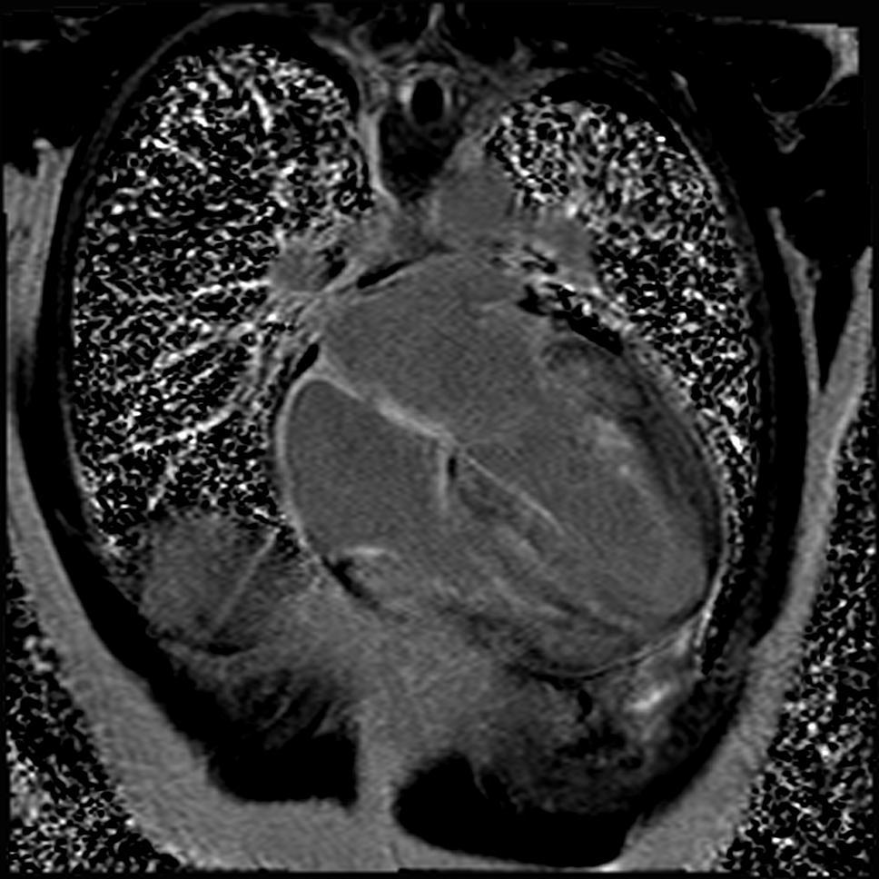 cardiac amyloidosis EMB