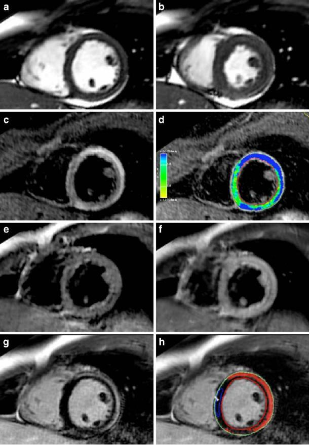 CMR and Cardiomyopathies Dynamic CMR For LV/RV mass, volumes and EF Perfusion CMR