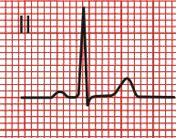 Lead II Lead II is a downward axis If the QRS has a positive deflection, the wave