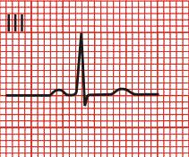 Lead III Lead III is a downward axis If the QRS has a positive deflection, the