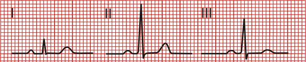 Axis: Putting it Together If the QRS is upright in leads I, II, and III then the axis is normal The