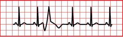 Premature Ventricular Complexes (PVC) The ventricles fire an early impulse