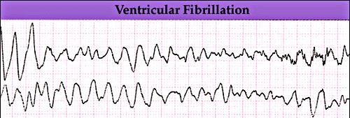 Ventricular Fibrillation Notice that the first 2