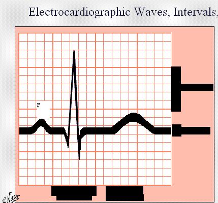 The ECG components P wave - represent atrial contraction or depolarization Duration = 3mm (3 small sq.) Height = 2.