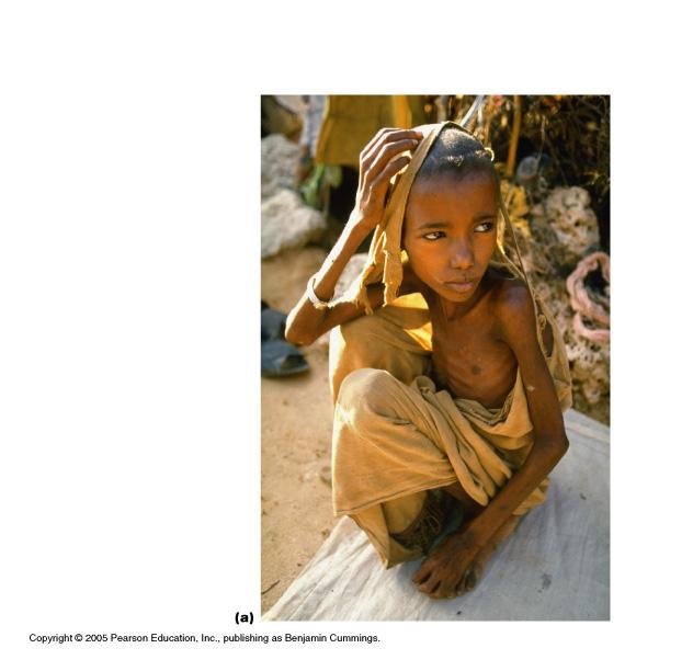 Protein Energy Malnutrition Disorder caused by inadequate intake of protein and energy.