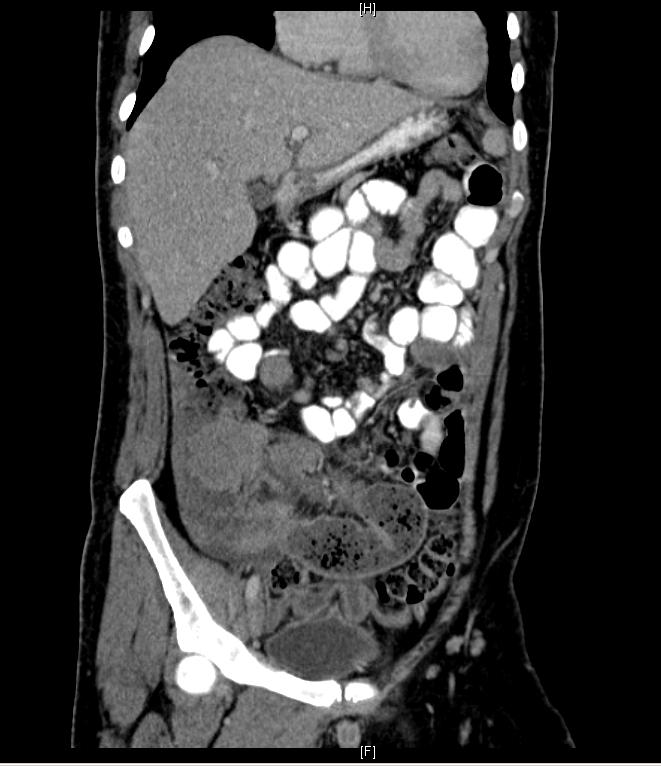cases such as this one, the history and physical may lead to a differential diagnosis other than acute abdomen.
