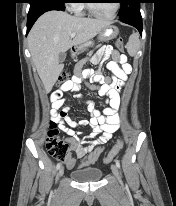 Figure 3. Contrast-enhanced CT of the abdomen and References pelvis following four cycles of CODOX/M-IVAC chemotherapy demonstrating complete response. 1. Blum KA, Lozanski G, Byrd JC.