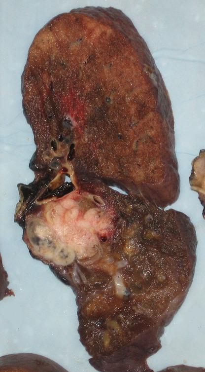 A squamouscell carcinoma (the whitish tumor)