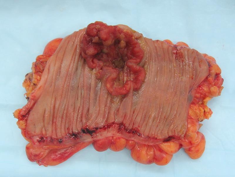 An invasive colorectal carcinoma
